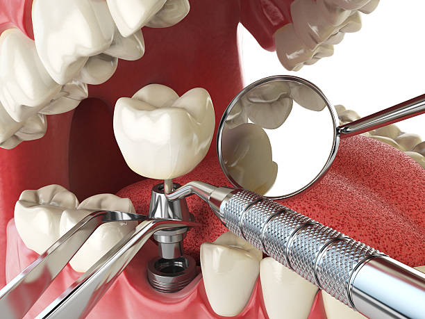 Best Knocked-Out Tooth (Avulsed Tooth) Treatment in Stuart, VA