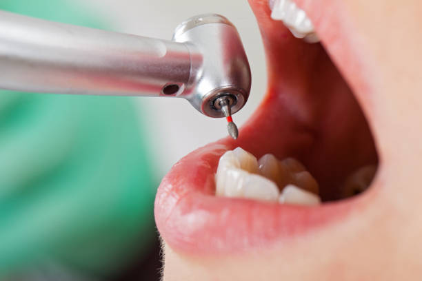 Best Emergency Root Canal Therapy in Stuart, VA